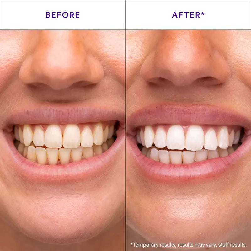 Hismile V34 Whitening Strips, Combining Whitening and Colour Correction